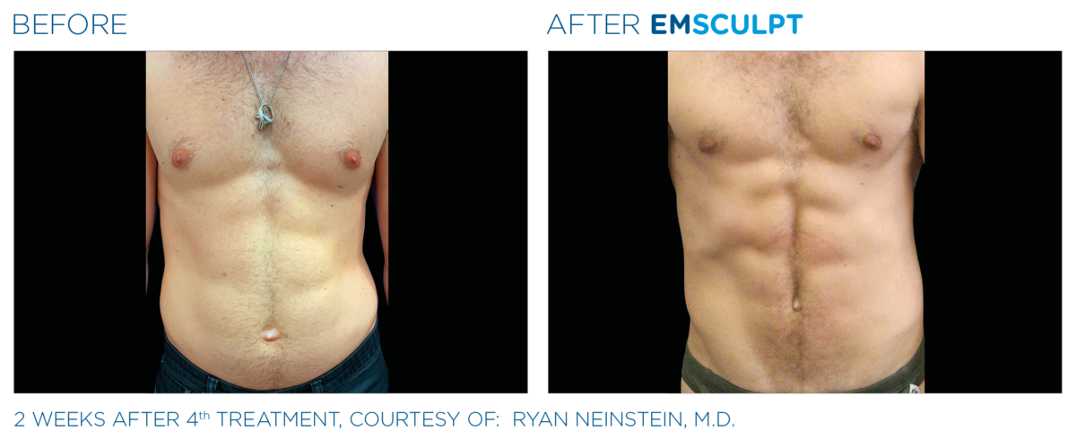 Emsculpt - Salt + Sweat Wellness